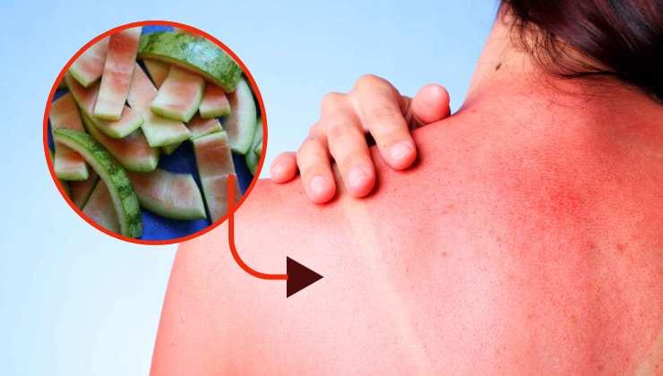 Cáscaras de sandía para quemaduras solares