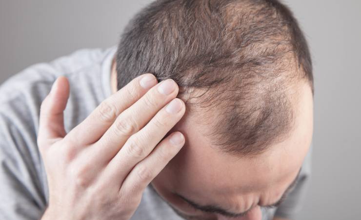 Perdida de cabello