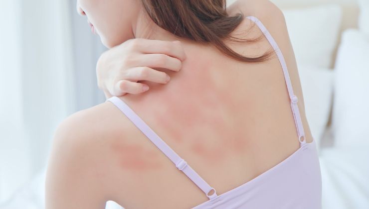 dermatitis